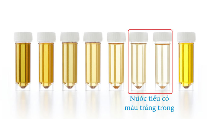 Nước tiểu trong vắt là dấu hiệu của uống nhiều nước